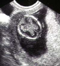 Так мальчик или девочка - 13 неделя беременности